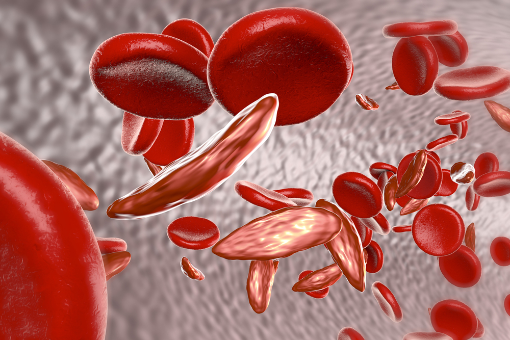 Sickle,Cell,Anemia,,3d,Illustration,Showing,Blood,Vessel,With,Normal